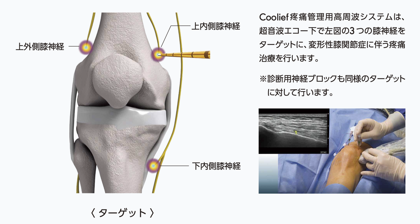 Coolief疼痛管理用高周波システムは、痛みを脳に知らせる膝の知覚神経を広範囲に焼灼し、疼痛を緩和することを目的とした治療です。超音波エコー下で右図の3つの膝神経をターゲットに、変形性膝関節症に伴う疼痛治療を行います。※診断用神経ブロックも同様のターゲットに対して行います。