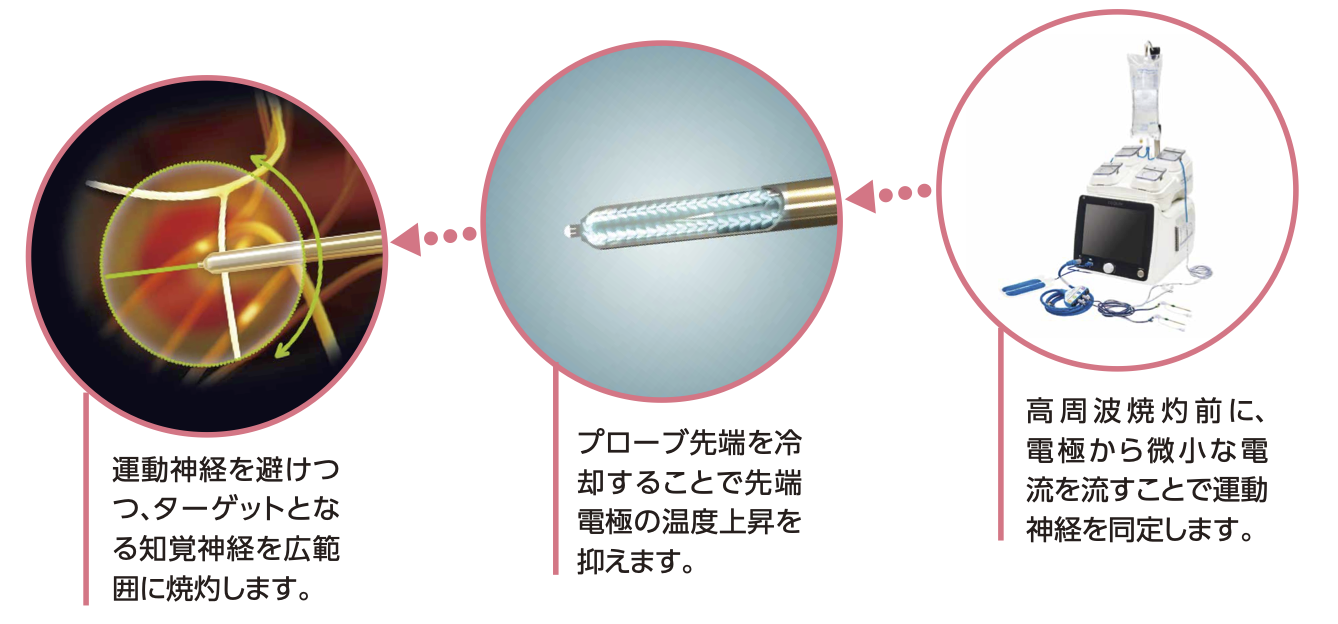 Coolief疼痛管理用高周波システム